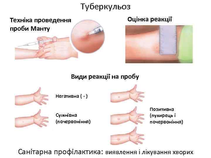 Туберкульоз Техніка проведення проби Манту Оцінка реакції Види реакції на пробу Негативна ( -