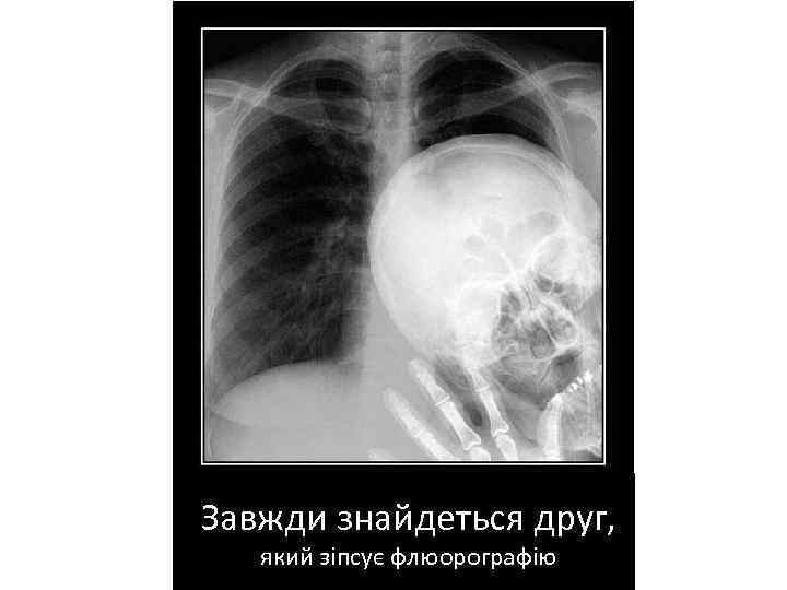 Завжди знайдеться друг, який зіпсує флюорографію 