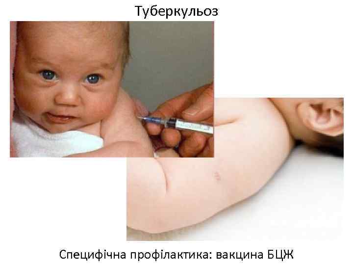 Туберкульоз Специфічна профілактика: вакцина БЦЖ 