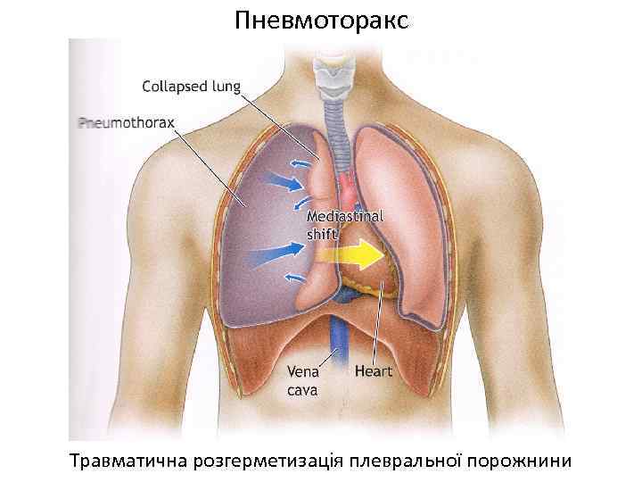 Пневмоторакс Травматична розгерметизація плевральної порожнини 