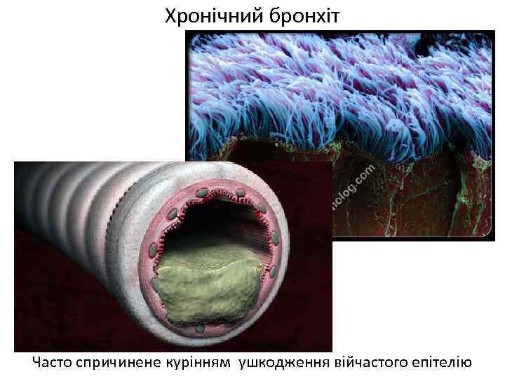 Хронічний бронхіт Часто спричинене курінням ушкодження війчастого епітелію 