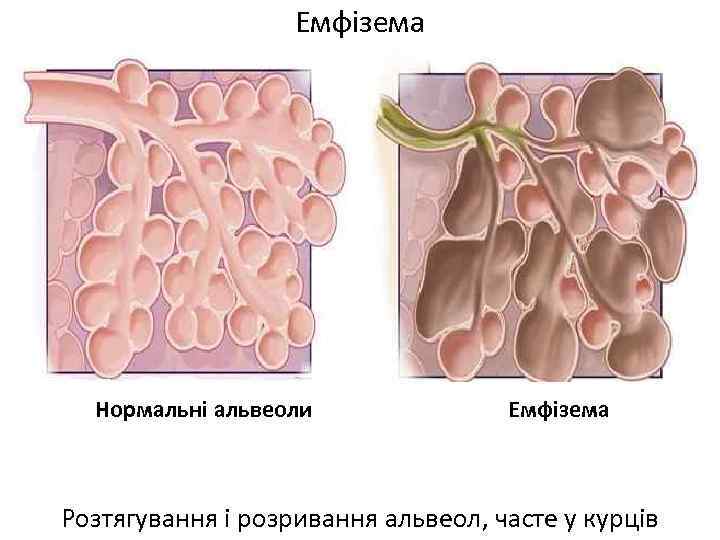 Емфізема Нормальні альвеоли Емфізема Розтягування і розривання альвеол, часте у курців 