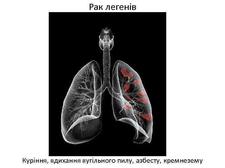 Рак легенів Куріння, вдихання вугільного пилу, азбесту, кремнезему 