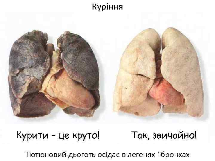 Куріння Курити – це круто! Так, звичайно! Тютюновий дьоготь осідає в легенях і бронхах