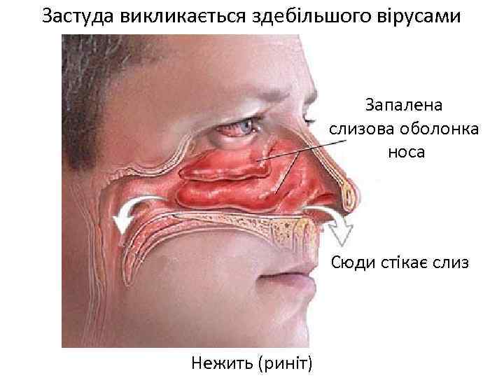 Застуда викликається здебільшого вірусами Запалена слизова оболонка носа Сюди стікає слиз Нежить (риніт) 