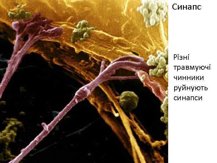 Синапс Різні травмуючі чинники руйнують синапси 