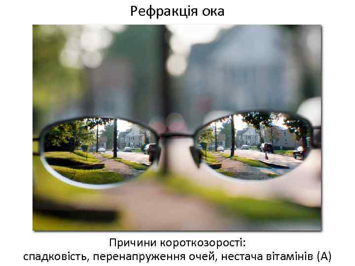 Рефракція ока Причини короткозорості: спадковість, перенапруження очей, нестача вітамінів (А) 