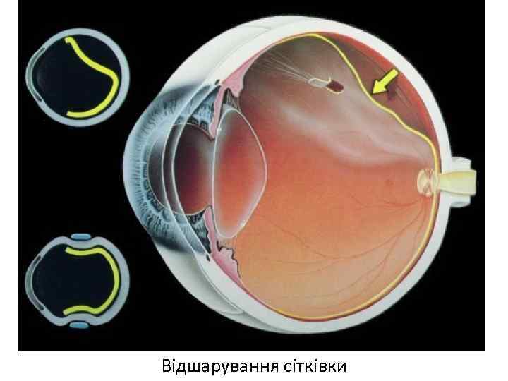 Сітківка ока Відшарування сітківки 
