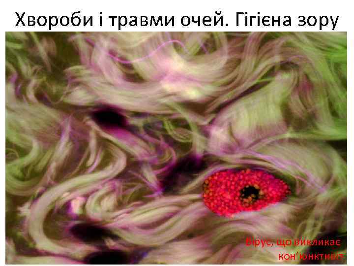 Хвороби і травми очей. Гігієна зору Вірус, що викликає кон’юнктивіт 