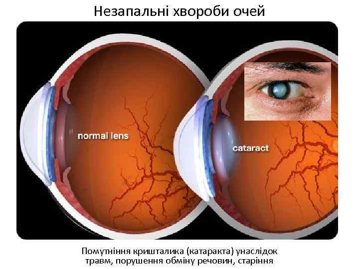 Незапальні хвороби очей Помутніння кришталика (катаракта) унаслідок травм, порушення обміну речовин, старіння 