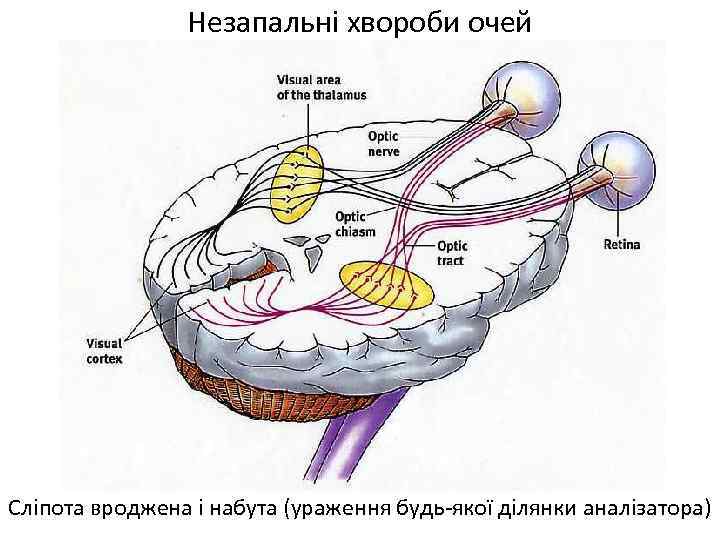 Незапальні хвороби очей Сліпота вроджена і набута (ураження будь-якої ділянки аналізатора) 