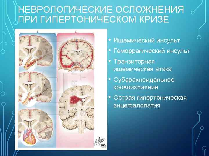 НЕВРОЛОГИЧЕСКИЕ ОСЛОЖНЕНИЯ ПРИ ГИПЕРТОНИЧЕСКОМ КРИЗЕ • Ишемический инсульт • Геморрагический инсульт • Транзиторная ишемическая