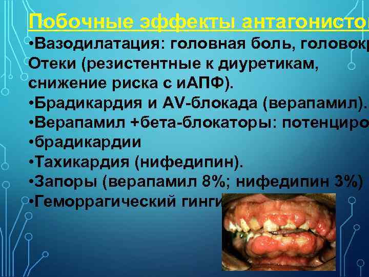 Побочные эффекты антагонистов • Вазодилатация: головная боль, головокр Отеки (резистентные к диуретикам, снижение риска