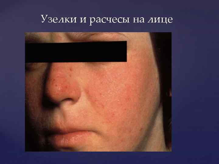 Узелки и расчесы на лице 