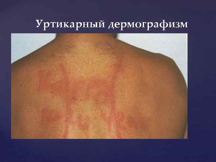 Уртикарный дермографизм 