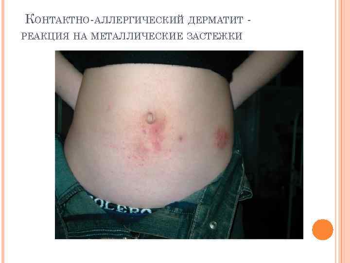  КОНТАКТНО-АЛЛЕРГИЧЕСКИЙ ДЕРМАТИТ РЕАКЦИЯ НА МЕТАЛЛИЧЕСКИЕ ЗАСТЕЖКИ 