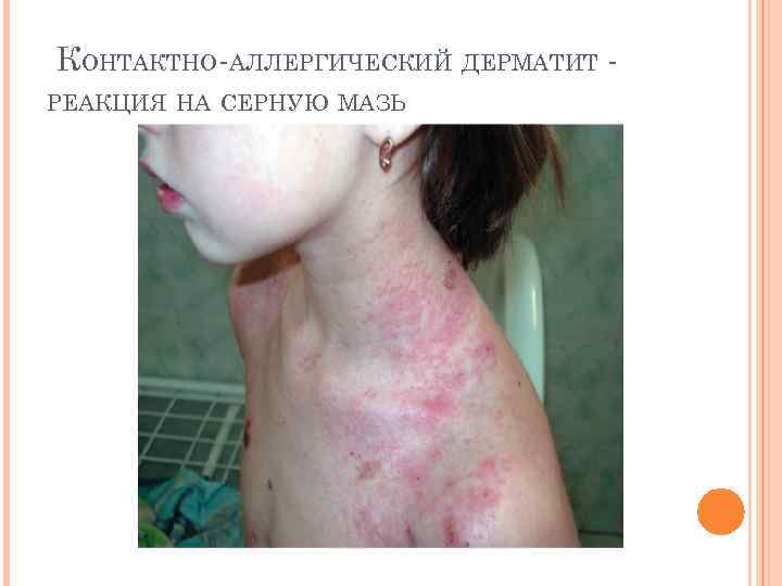  КОНТАКТНО-АЛЛЕРГИЧЕСКИЙ ДЕРМАТИТ РЕАКЦИЯ НА СЕРНУЮ МАЗЬ 
