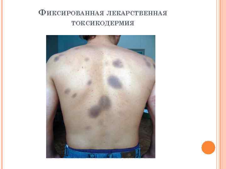 ФИКСИРОВАННАЯ ЛЕКАРСТВЕННАЯ ТОКСИКОДЕРМИЯ 