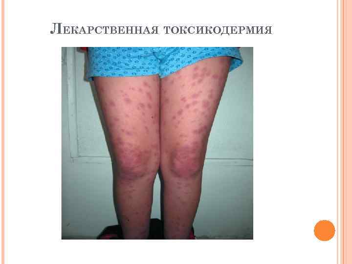 ЛЕКАРСТВЕННАЯ ТОКСИКОДЕРМИЯ 