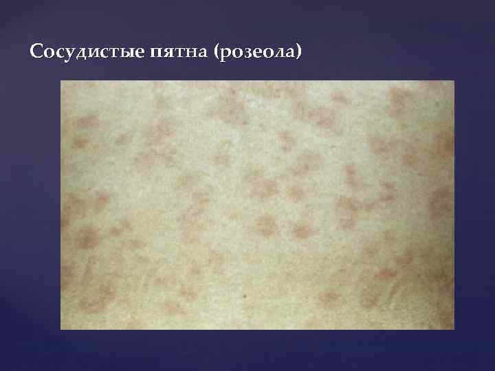 Сосудистые пятна (розеола) 