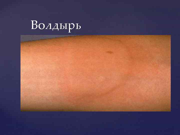 Волдырь 