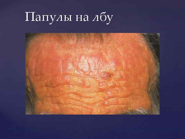 Папулы на лбу 