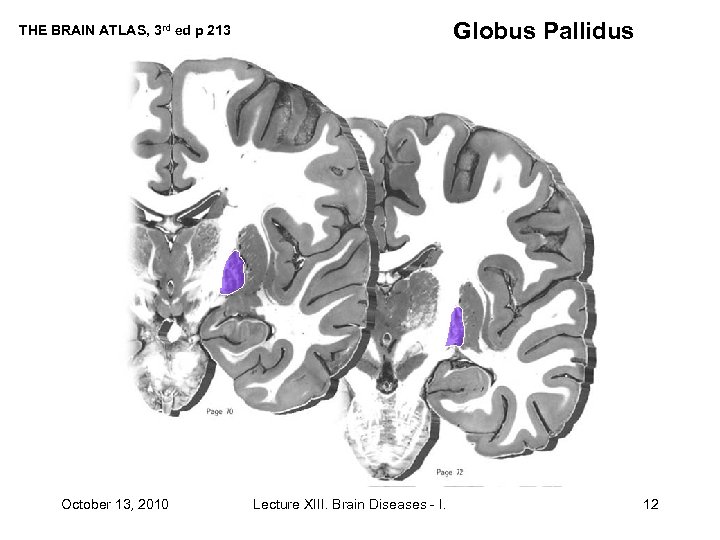 Globus Pallidus THE BRAIN ATLAS, 3 rd ed p 213 October 13, 2010 Lecture