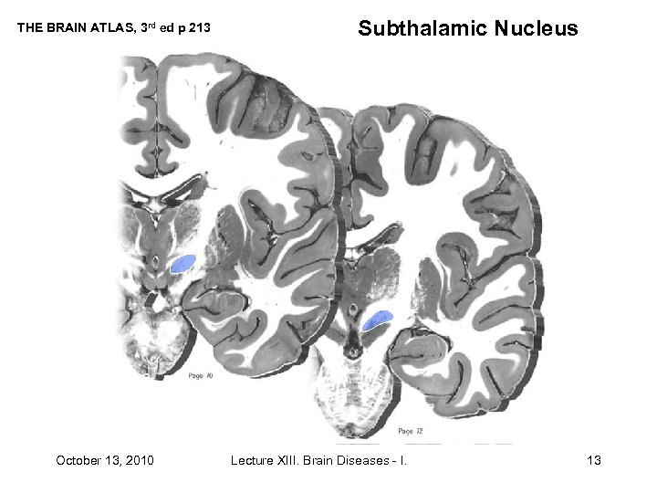 THE BRAIN ATLAS, 3 rd ed p 213 October 13, 2010 Subthalamic Nucleus Lecture