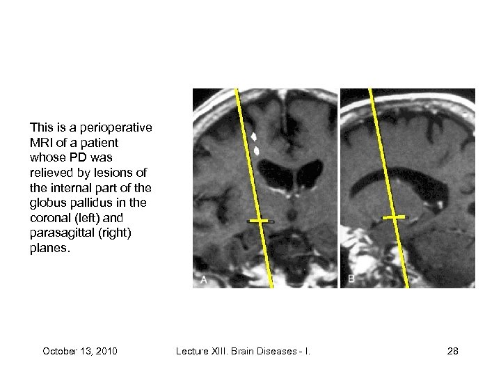 This is a perioperative MRI of a patient whose PD was relieved by lesions