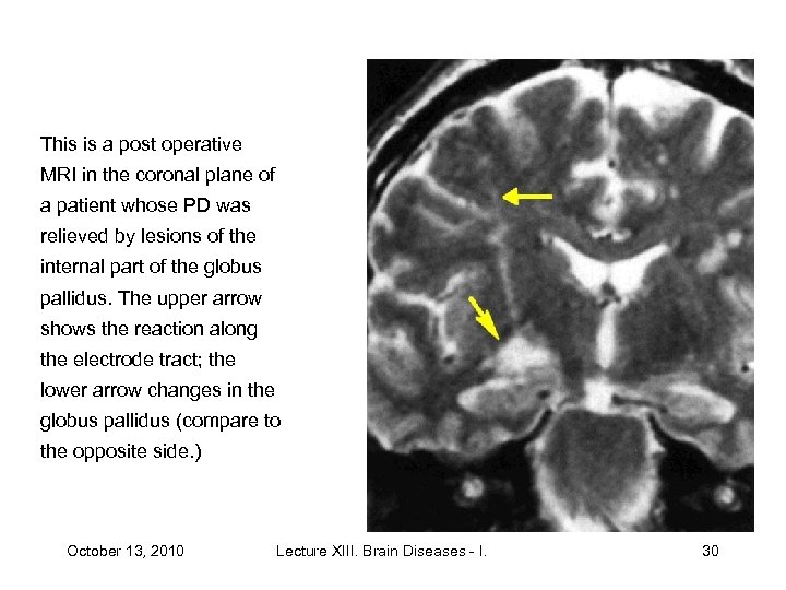 This is a post operative MRI in the coronal plane of a patient whose