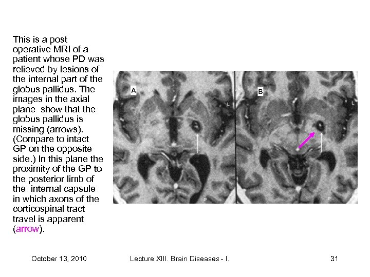 This is a post operative MRI of a patient whose PD was relieved by