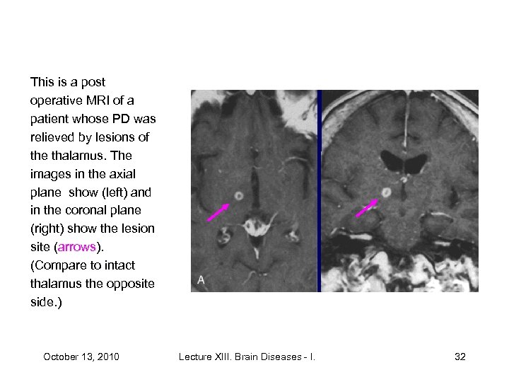 This is a post operative MRI of a patient whose PD was relieved by