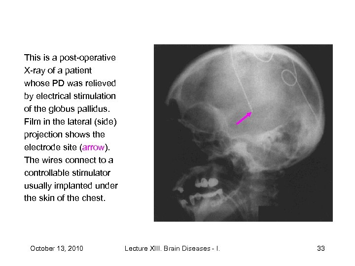 This is a post-operative X-ray of a patient whose PD was relieved by electrical