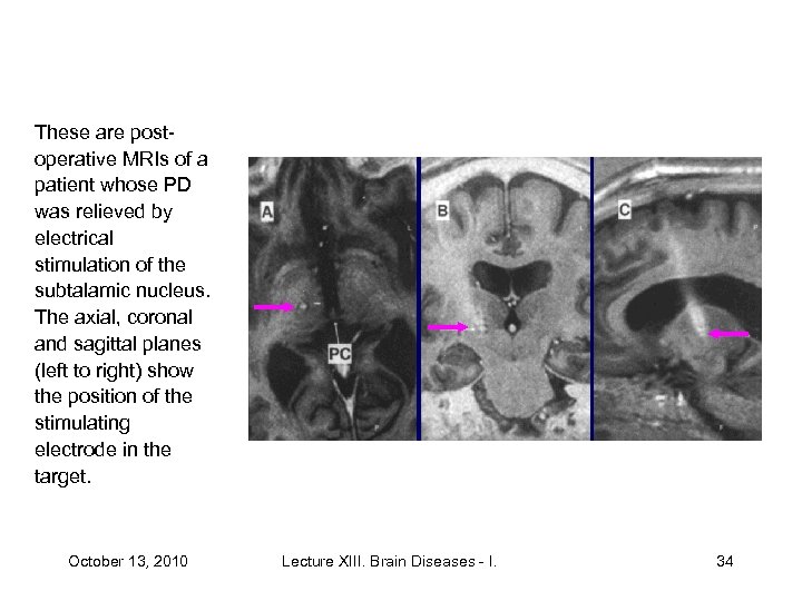 These are postoperative MRIs of a patient whose PD was relieved by electrical stimulation