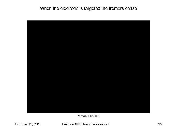 When the electrode is targeted the tremors cease Movie Clip # 3 October 13,