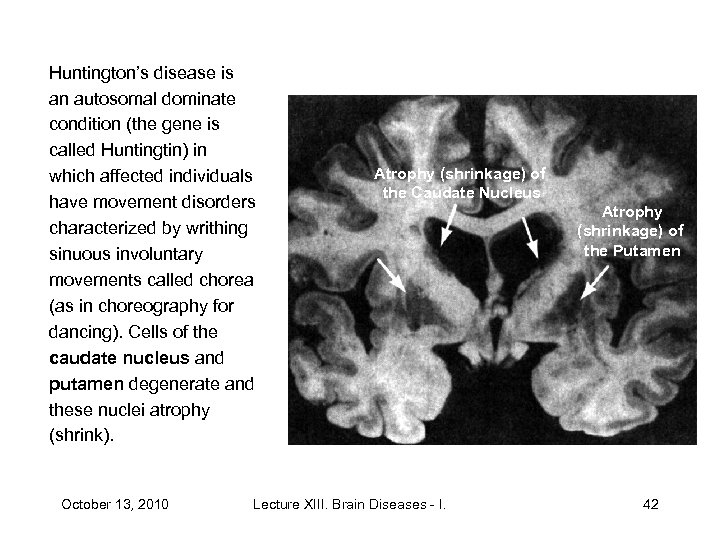 Huntington’s disease is an autosomal dominate condition (the gene is called Huntingtin) in which