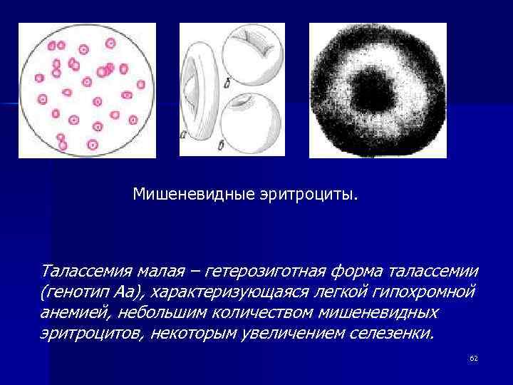 Мишеневидные эритроциты. Талассемия малая – гетерозиготная форма талассемии (генотип Аа), характеризующаяся легкой гипохромной анемией,