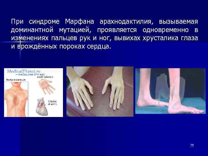 При синдроме Марфана арахнодактилия, вызываемая доминантной мутацией, проявляется одновременно в изменениях пальцев рук и