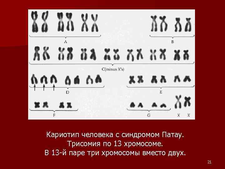 Общий кариотип. Нормальный кариотип человека 46 хромосом. Синдром трисомии х кариотип. Кариотип человека с синдромом Патау. Кариотип человека с трисомией 13.