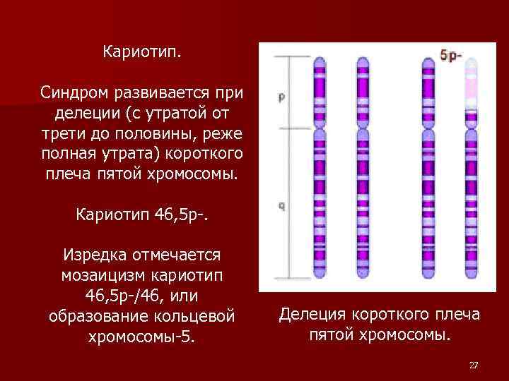Мужская хромосома 5. Делеция 5 хромосомы синдром. Делеция плеча 5 хромосомы.