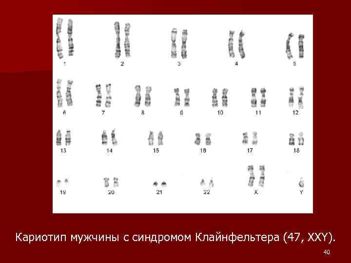 Синдром клайнфельтера и шерешевского тернера