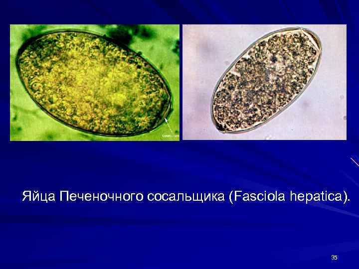 Печеночный сосальщик диагностика. Fasciola hepatica яйца. Яйца гельминтов Fasciola hepatica. Яйца печеночного сосальщика микроскоп. Fasciola hepatica яйца строение.