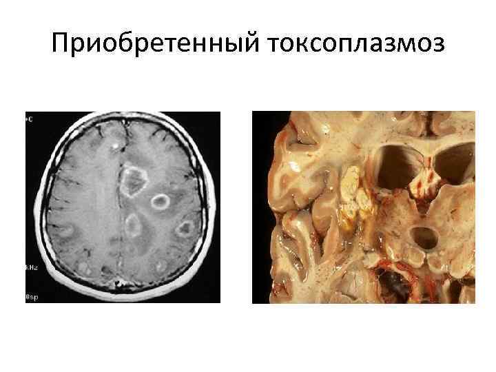 Приобретенный токсоплазмоз 