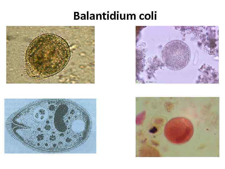 Balantidium coli 