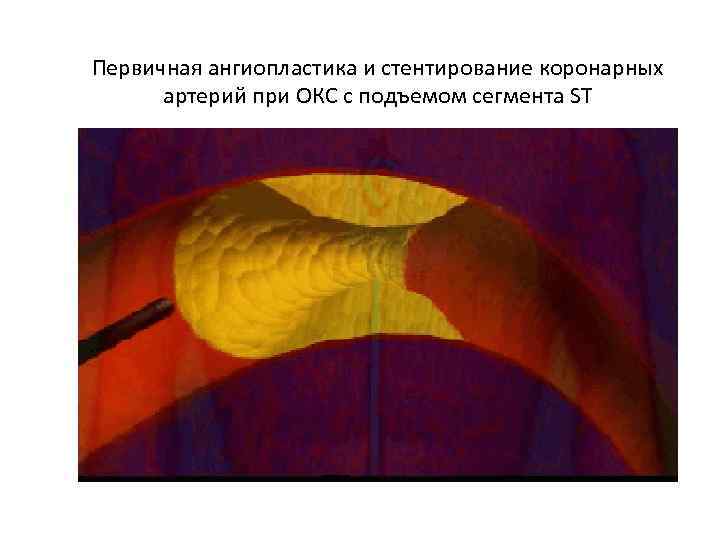 Первичная ангиопластика и стентирование коронарных артерий при ОКС с подъемом сегмента ST 