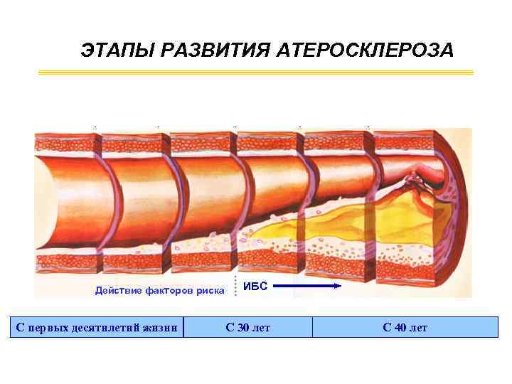 ЭТАПЫ РАЗВИТИЯ АТЕРОСКЛЕРОЗА Здоровая артерия Жировая полоска Переходное повреждение Действие факторов риска С первых