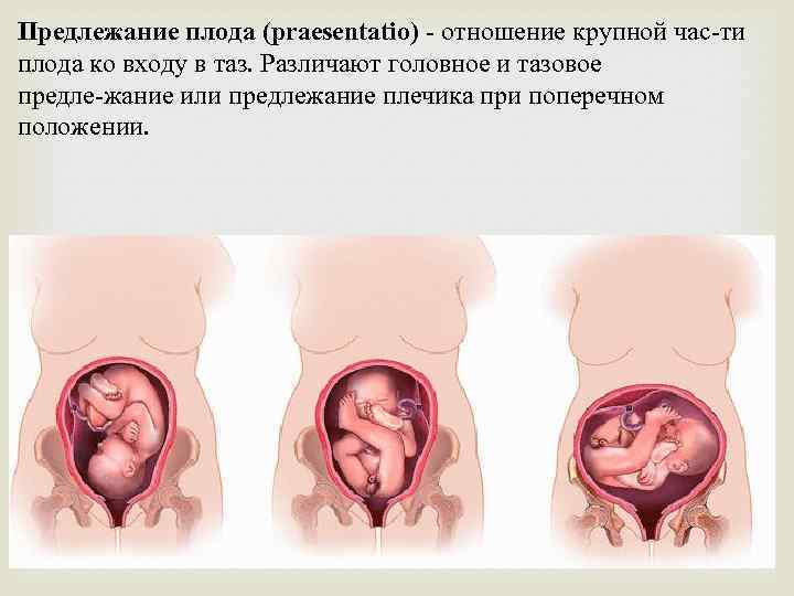 Предлежание плода (praesentatio) отношение крупной час ти плода ко входу в таз. Различают головное