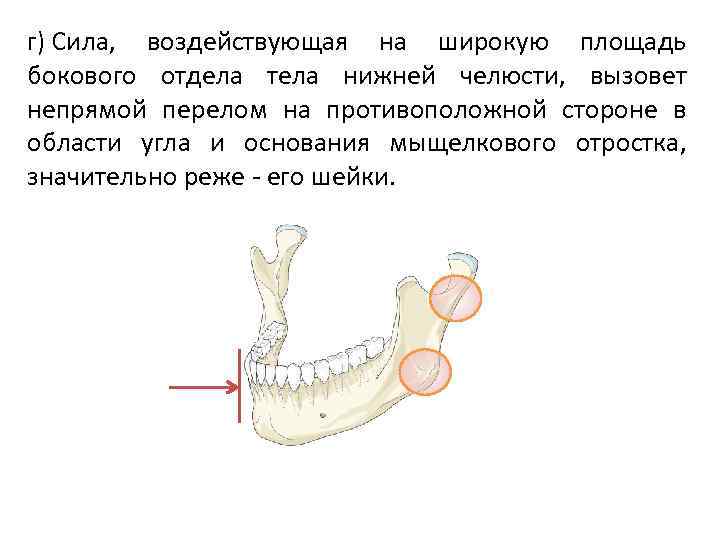 Перелом мыщелкового отростка нижней челюсти. Механизм перелома мыщелкового отростка нижней челюсти. Мыщелковый отросток нижней челюсти перелом. Перелом бокового отдела тела нижней челюсти. Перелом мыщелкового отростка нижней челюсти кт.