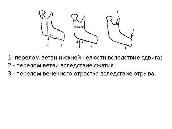 Перелом нижней. Перелом венечного отростка челюсти. Переломы ветви нижней челюсти классификация. Перелом венечного отростка нижней челюсти. Перелом венечного отростка нижней челюсти лечение.