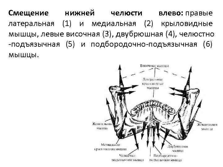 Смещение нижней челюсти влево: правые латеральная (1) и медиальная (2) крыловидные мышцы, левые височная